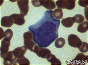 Mononucleosis - photomicrograph of cells - Illustration Thumbnail              