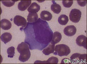 Infectious mononucleosis #3 - Illustration Thumbnail              