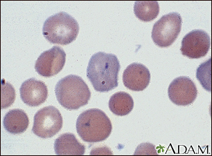 Blood smear Information | Mount Sinai - New York