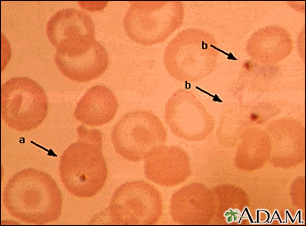 Malaria, photomicrograph of cellular parasites - Illustration Thumbnail
                      