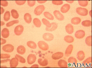Ovalocytosis