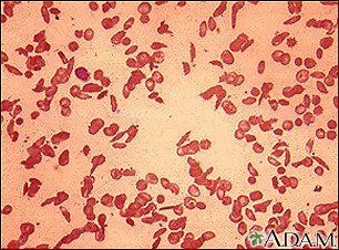 Red blood cells - sickle cells