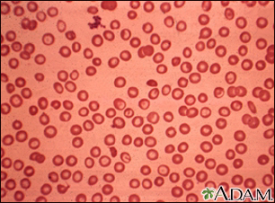 Thalassemia minor - Illustration Thumbnail
                      