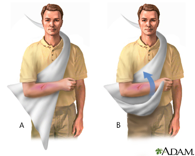 How To Apply A Sling, Orthosports Orthopaedic Surgeons