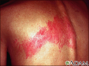 Herpes zoster (shingles) on the back - Illustration Thumbnail
                      