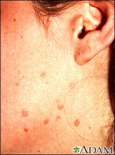 skin warts on face and neck
