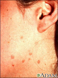 hpv flat warts