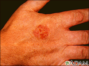 Bowen's disease on the hand - Illustration Thumbnail
                      