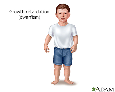 growth hormone deficiency dwarfism