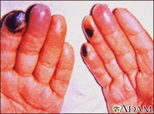 Cryoglobulinemia of the fingers - Illustration Thumbnail              