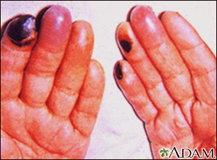 Cryoglobulinemia of the fingers - Illustration Thumbnail
                      