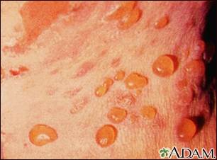 mild bullous pemphigoid