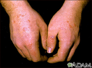 Erythema multiforme on the hands - Illustration Thumbnail
                      