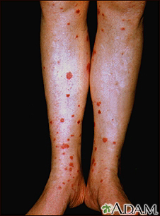 Purpura: Blood Spots, Thrombocytopenic, Symptoms & Causes