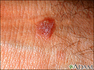 Derm Dx: Asymptomatic Blisters on a Child's Upper Leg - Clinical