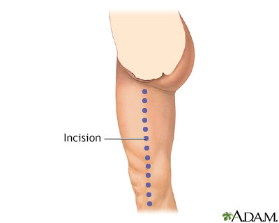 HIE Multimedia - Peripheral artery disease - legs