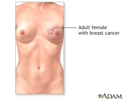 Breast reconstruction - series - Indication, part 1