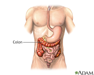 Colon diverticula - series - Presentation Thumbnail              