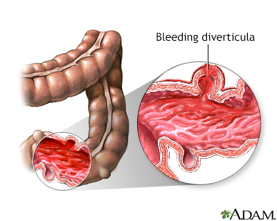 blood in stool upper gi tract