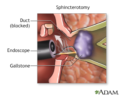 common bile duct. in the common bile duct,
