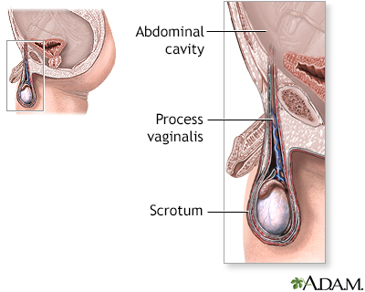 Hydrocele repair Information