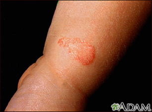 Ringworm - tinea corporis on an infant's leg - Illustration Thumbnail
              