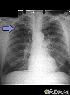 abnormal chest x ray images