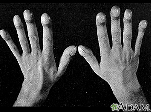 Clubbing of the fingers or toes Information | Mount Sinai - New York