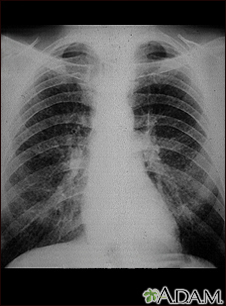 Coal worker's lungs - chest x-ray - Illustration Thumbnail              