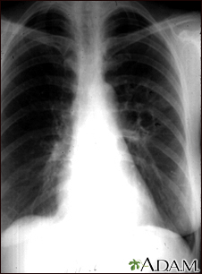 Coccidioidomycosis - chest X-ray - Illustration Thumbnail              