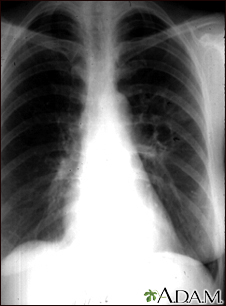 Coccidioidomycosis - chest X-ray - Illustration Thumbnail
                      