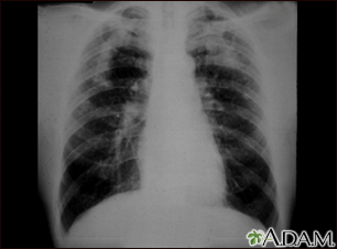 interstitial pneumonia x ray