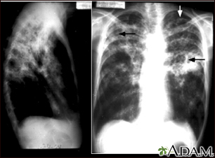 tuberculosis vs pneumonia x ray