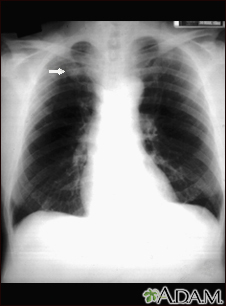 Pulmonary nodule - front view chest x-ray - Illustration Thumbnail
                      