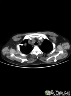 Pulmonary nodule, solitary - CT scan - Illustration Thumbnail
              