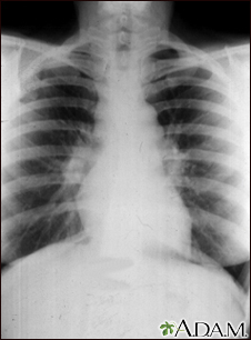 Sarcoid, stage I - chest X-ray - Illustration Thumbnail              