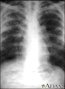 tuberculosis vs pneumonia x ray