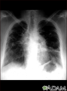 Sarcoid, stage IV - chest x-ray - Illustration Thumbnail              