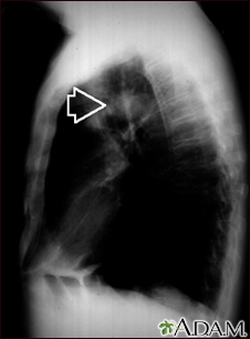 Pulmonary mass - side view chest X-ray - Illustration Thumbnail
              