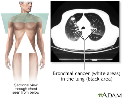 Bronchial cancer - CT scan - Illustration Thumbnail
                      