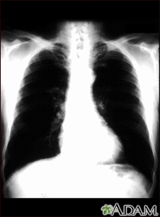 Bronchial cancer - chest X-ray - Illustration Thumbnail
                      