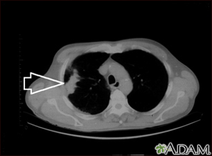 Lung mass, right lung - CT scan - Illustration Thumbnail
                      