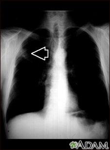 Lung mass, right upper lung - chest X-ray - Illustration Thumbnail              