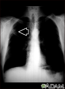 Lung mass, right upper lung - chest X-ray - Illustration Thumbnail
              