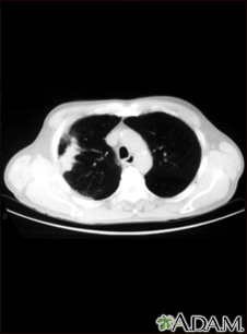 Lung with squamous cell cancer - CT scan - Illustration Thumbnail