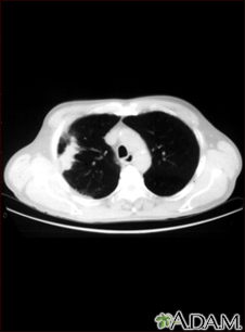 Lung with squamous cell cancer - CT scan - Illustration Thumbnail              