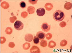 Erythroblastosis fetalis - photomicrograph - Illustration Thumbnail              