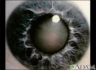 Cataract - close-up of the eye - Illustration Thumbnail              