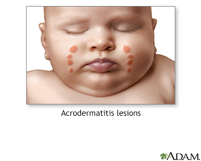 Acrodermatitis - Illustration Thumbnail
                      