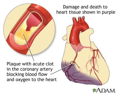 Heart attack - what to ask your doctor Information